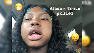 GOT ALL 4 WISDOM TEETH PULLED IN ONE DAY‼️ ||KARMEL LING||