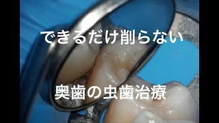 歯間離開器を使った虫歯治療（奥歯）