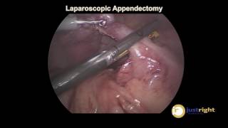 Laparoscopic Appendectomy - JustRight 5mm Stapler Highlight Clip