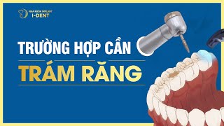 NHỮNG TRƯỜNG HỢP NÀO NÊN TRÁM RĂNG