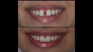 diastema closure using bioclear method