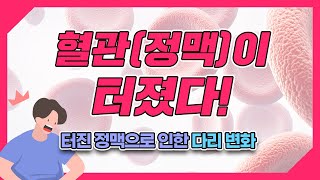 하지정맥류 환자의 정맥이 만약 터졌을 경우 다리에 나타나는 변화와 치료방법은?