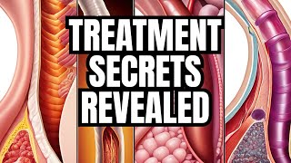 Barrett's Esophagus: Secrets to Treatment