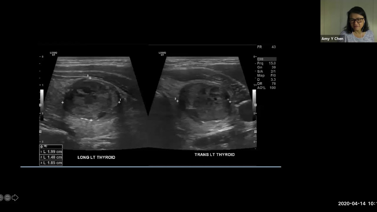 Thyroid Case Presentations Dr Amy Chen Youtube
