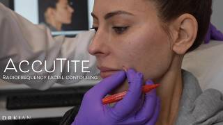 AccuTite Skin Tightening \u0026 Facial Contouring with Dr. Kian Karimi