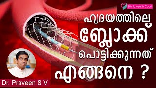 How heart blocks are removed|ഹൃദയത്തിലെ ബ്ലോക്ക് പൊട്ടിക്കുന്നത് എങ്ങനെയൊക്കെയാണ്?|EthnicHealthCourt