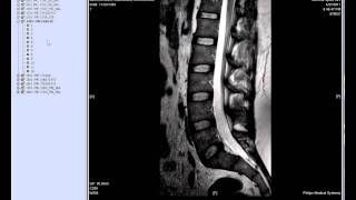 MRI for Abdulaziz Bin Dakheel (vedio)