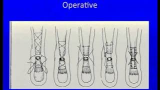 Acute Achilles Tendon Rupture: Instructional Lecture and Debates