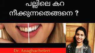 #Teethstain#Dentalk Teethstain-causes,treatment|പല്ലിലെകറ-കാരണങ്ങൾ പരിഹാരമാർഗങ്ങൾ|DrAnaghacheleri