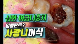 심한 어금니충치 임플란트 대신 사랑니이식 자가치아이식/치아재식술