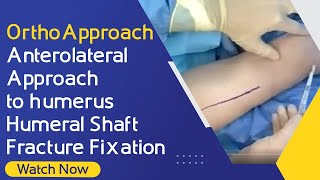 OrthoApproach - Anterolateral Approach to Humerus | Humeral Shaft Fracture Fixation