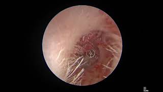 total endoscopic ossiculoplasty