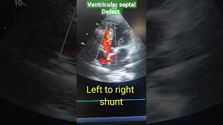 VSD (ventricular septal defect) in Echo, left to right shunt #youtubeshorts #shortsvideo #shorts