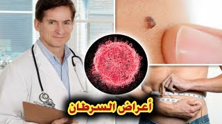 أعراض مرض السرطان | 7 علامات تحذيرية تخبرك بالإصابة بمرض السرطان