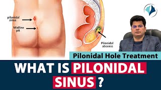 What is Pilonidal Sinus? | Role of Plastic Surgeon in Pilonidal Sinus | Dr. Pankaj Mehta