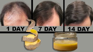 I'm shocked! After 14 days of use, the hair on my bald spot is growing like crazy!