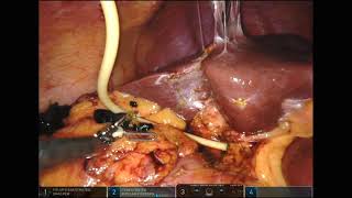 Robotic common bile duct exploration and t tube placement, completion cholangiogram not pictured