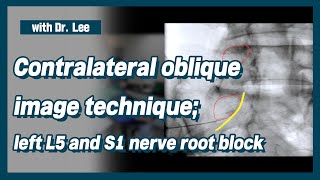 Trailer_Learn contralateral oblique C-arm image anatomy  for  L5, S1 nerve root block