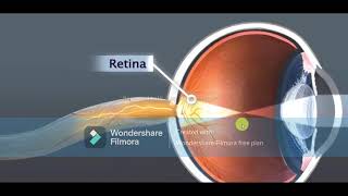 Cataract (የአይን ሞራ ግርዶሽ )