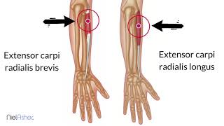 Tennis Elbow - How To Find Trigger Points