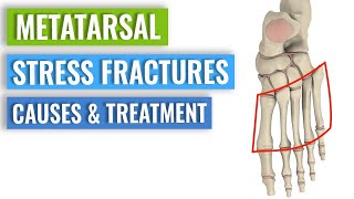 Metatarsal Stress Fractures - Causes, Treatment, Prevention