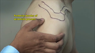 Subacromial Injection - Posterior Approach