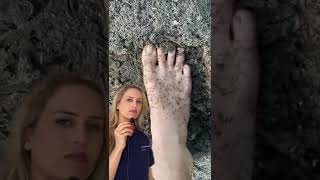 Doctor reacts: stepping on an anthill