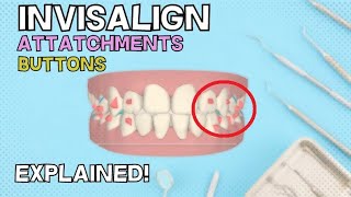 Invisalign Attachments and Buttons | How do they work? - Explained in 4 minutes!