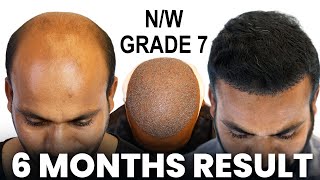 Grade 7 Hair Transplant Result India | 6000 Grafts |