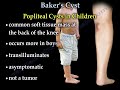 baker s cyst of the knee meniscus tear arthritis of the knee.