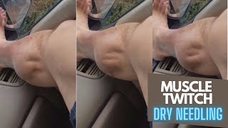 Dry Needling - Muscle Twitch