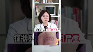 得了蛇缠腰，偏方谣言不可信，30秒教你急救 蛇缠腰  带状疱疹  偏方  医学科普  抖出健康知识宝藏