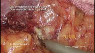 Cirrhosis: Completion Cholecystectomy