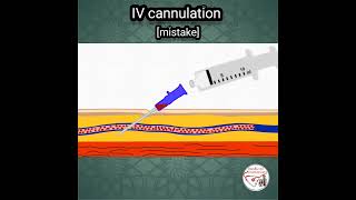 ❌️ IV CANNULATION | MISTAKE