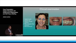 Case Presentation: Implant Placement with GBR and Soft Tissue Grafting | Johann Lochner