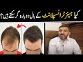 Can Hair Transplated Hairs Fall or weak Again || کیا ہیئر ٹرانسپلانٹ کے بعد بال دوبارہ گر سکتے ہیں