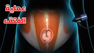 شاهد عملية الفتق _ Hernia surgery 3Dmedical animation