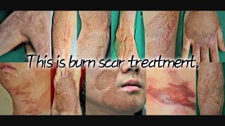 Burn Scar Reconstruction | Real Cases Before & After (Severe to Mild)