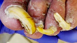 You've Never Seen Toenails So Long![Doctor Liu Pedicure]