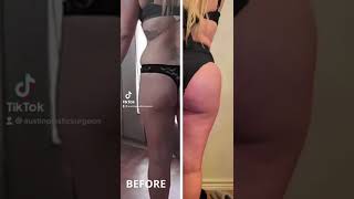 Before and After BBL and Butt Implants