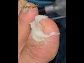 Ingrown Removal