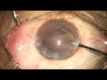 phacoemulsification in a polar cataract pitfalls and pearls