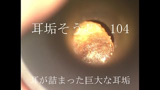 耳垢そうじ/3cmを超える巨大な耳垢/104