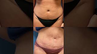 Tummy Tuck recovery - Check out the scar #shorts #tummytuckprocedure #tummytuckjourney