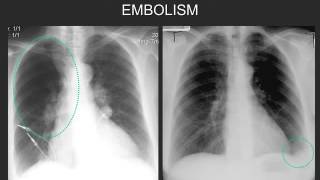 APPROACH TO PUL EMBOLISM  559