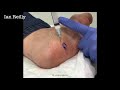 video plantar fibroma with csi peppering