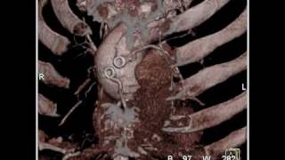 Cardiac: Type A dissection (4 of 6)