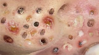 Loan Nguyen Acne Treatment 47x