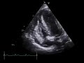 Echocardiogram, pericardial effusion compressing RV and RA, signs of impending cardiac tamponade