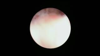 Dr. Caitlin Jago - Hysteroscopy for Retained Products of Conception